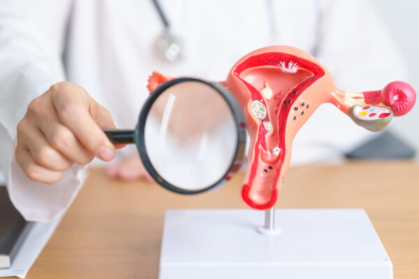 Polycystic Ovary Syndrome (PCOS): The Most Common Gynecological Disorder